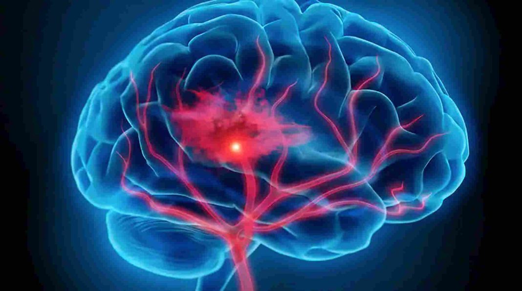 স্ট্রোক প্রতিরোধে রক্তচাপ নিয়ন্ত্রণ: জীবন বাঁচানোর কার্যকরী উপায়