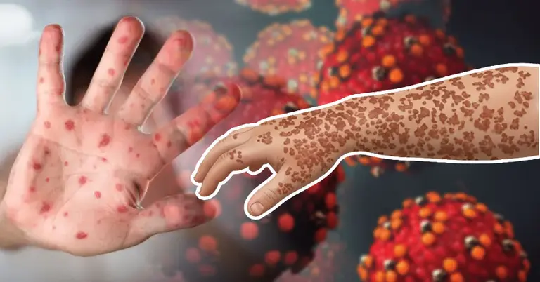 হাম রোগ কেন হয়